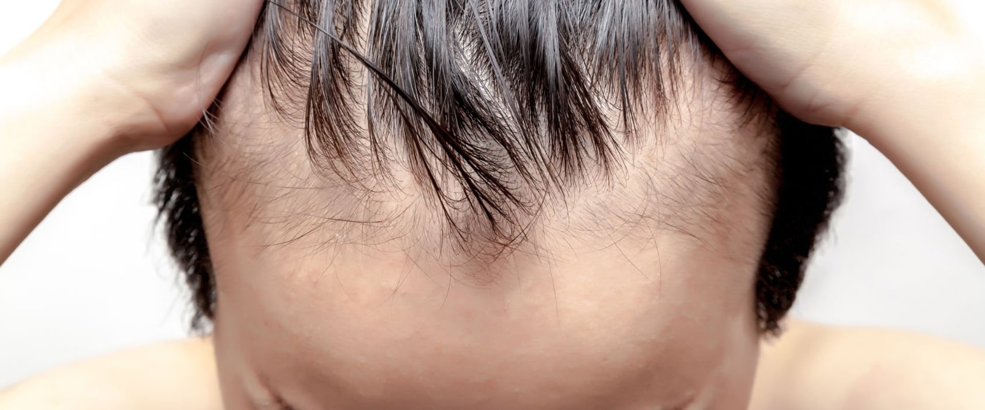 All You Need to Know About Male Pattern Baldness