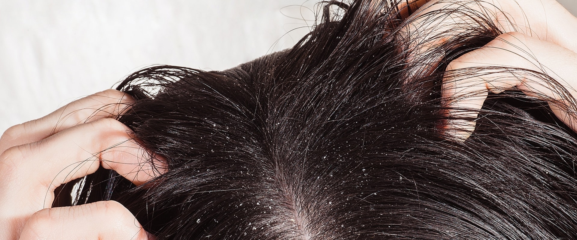 Scalp Exfoliation and Deep Cleaning: The Key to Preventing Hair Loss