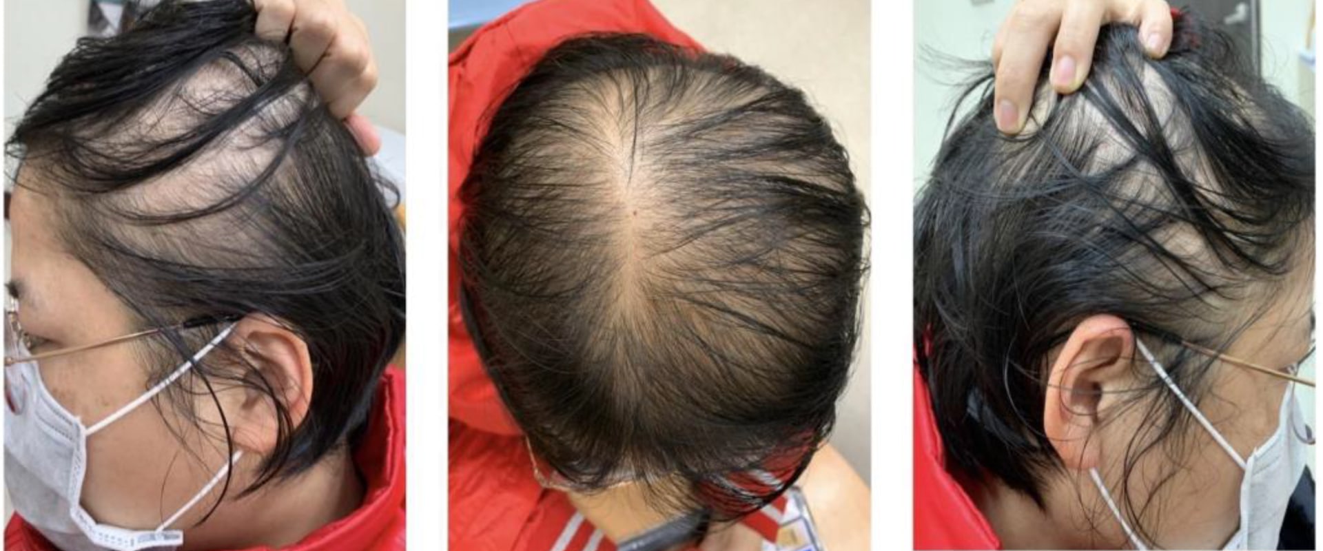 Understanding Female Pattern Hair Loss