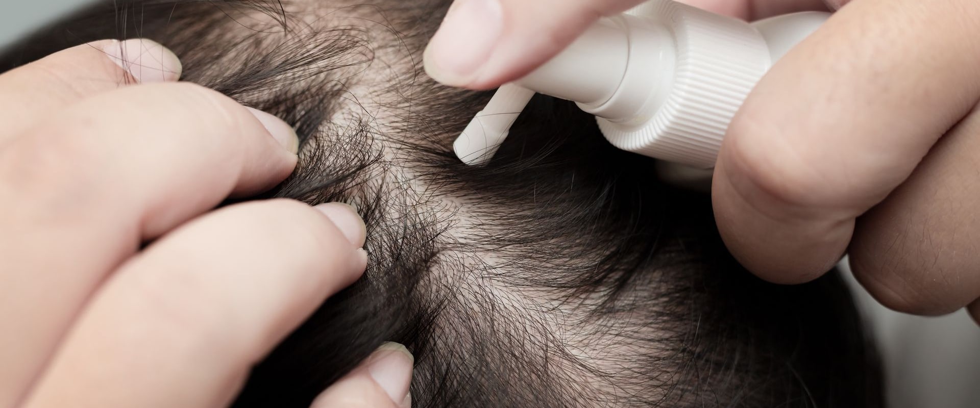 Understanding Minoxidil: A Comprehensive Look at Hair Loss Treatments and Solutions