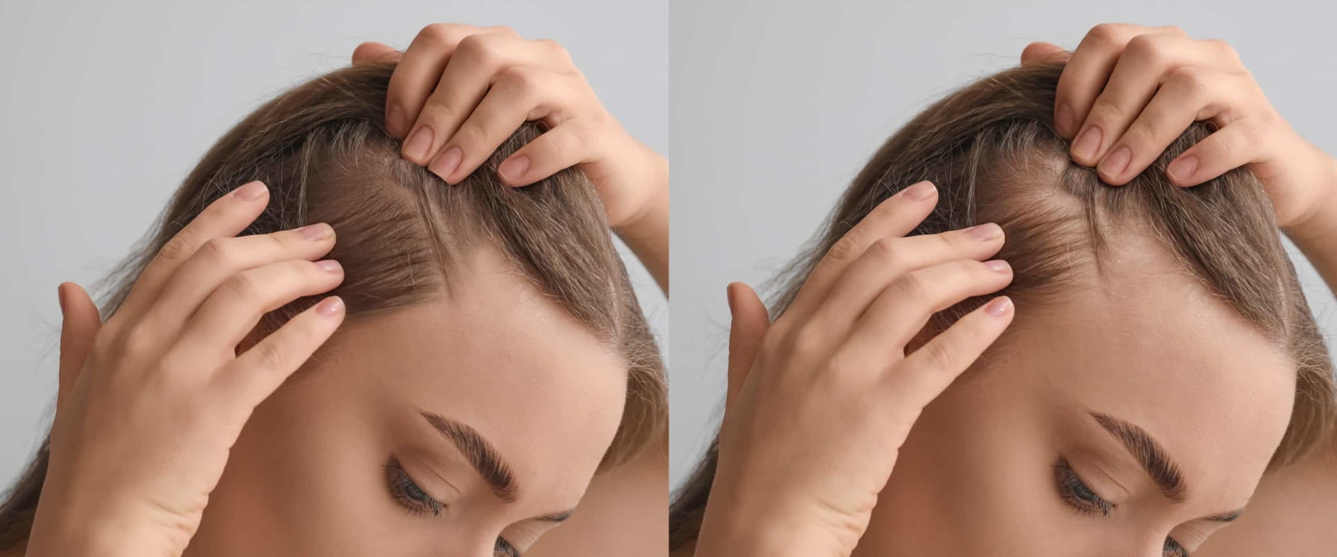 Understanding Female Hair Loss: Causes, Treatments, and Prevention