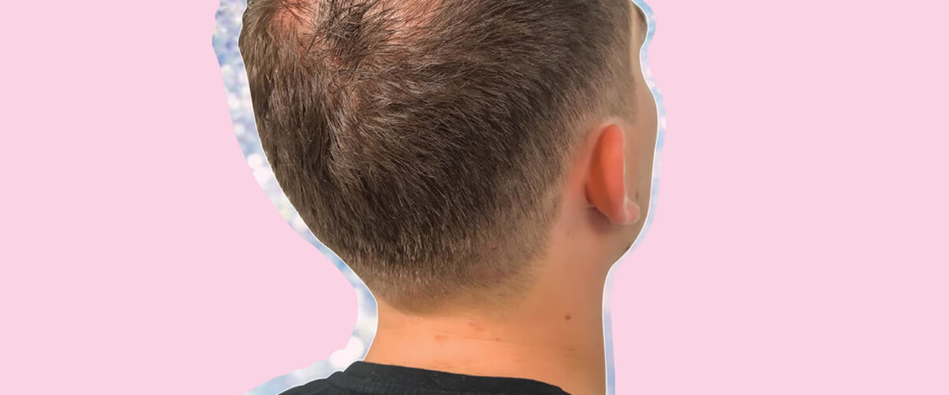 Understanding Male Pattern Baldness: Causes, Prevention, and Treatment