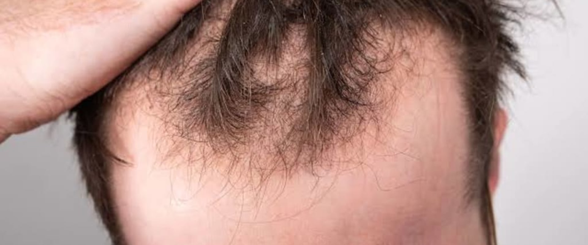 Understanding Hereditary Hair Loss: Causes, Prevention, and Treatment