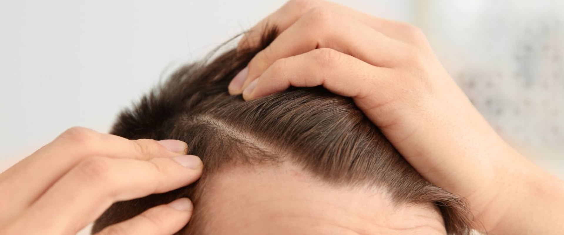 Understanding Finasteride: A Comprehensive Guide to Preventing Hair Loss