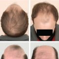 Diagnosing Male Pattern Baldness: Understanding Causes, Prevention, and Treatment Options