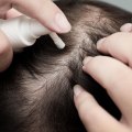 Understanding Minoxidil: A Comprehensive Look at Hair Loss Treatments and Solutions