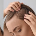 Understanding Female Hair Loss: Causes, Treatments, and Prevention