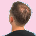 Understanding Male Pattern Baldness: Causes, Prevention, and Treatment