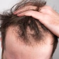 Understanding Hereditary Hair Loss: Causes, Prevention, and Treatment