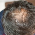 Hair Care Routine for Healthy Hair: Tips and Techniques to Prevent Baldness and Promote Regrowth