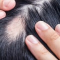 Understanding Alopecia: Causes, Treatments, and Prevention