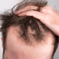 Stress Management for Hair Health: Tips and Techniques for Preventing Baldness and Promoting Regrowth