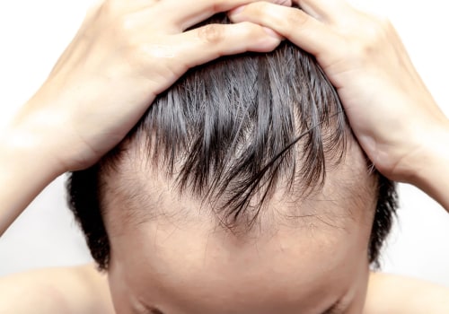 All You Need to Know About Male Pattern Baldness