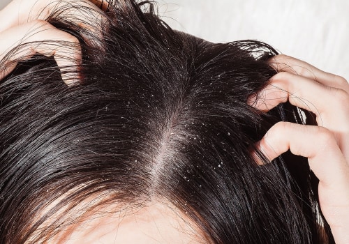 Scalp Exfoliation and Deep Cleaning: The Key to Preventing Hair Loss