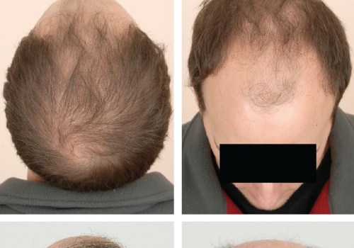 Diagnosing Male Pattern Baldness: Understanding Causes, Prevention, and Treatment Options