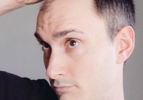 Lifestyle Changes for Preventing Male Pattern Baldness