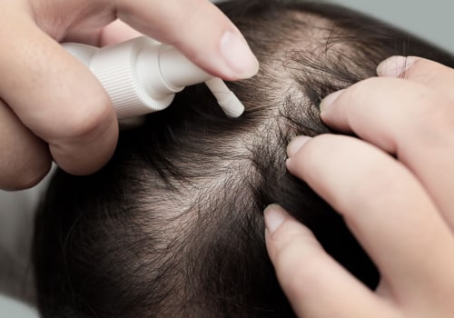 Understanding Minoxidil: A Comprehensive Look at Hair Loss Treatments and Solutions