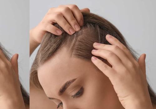 Understanding Female Hair Loss: Causes, Treatments, and Prevention