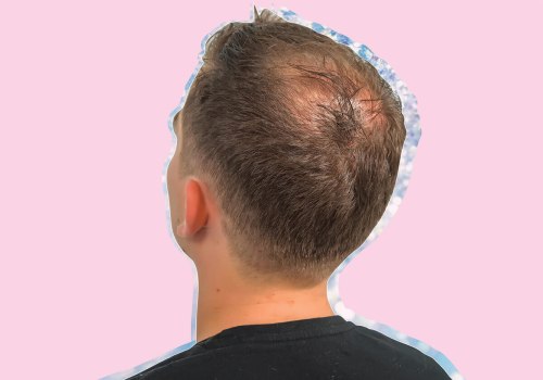 Understanding Male Pattern Baldness: Causes, Prevention, and Treatment