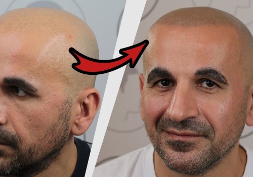 Scalp Camouflage Techniques: A Comprehensive Guide to Preventing Hair Loss and Restoring Your Confidence