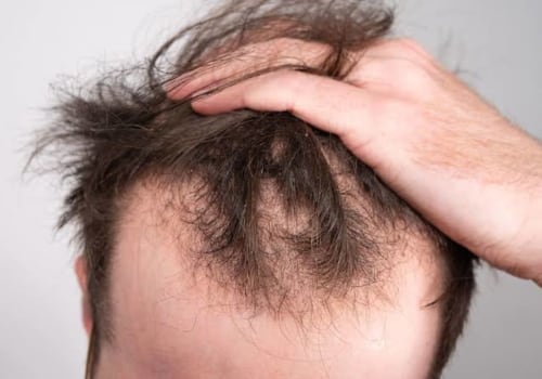 Understanding Hereditary Hair Loss: Causes, Prevention, and Treatment