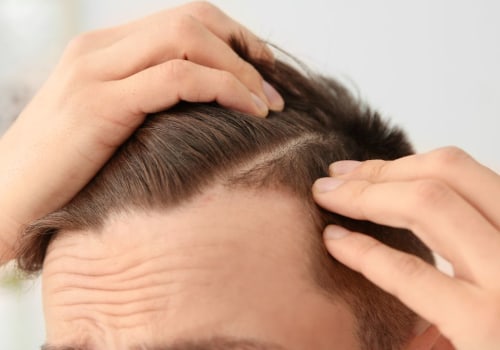 Understanding Finasteride: A Comprehensive Guide to Preventing Hair Loss