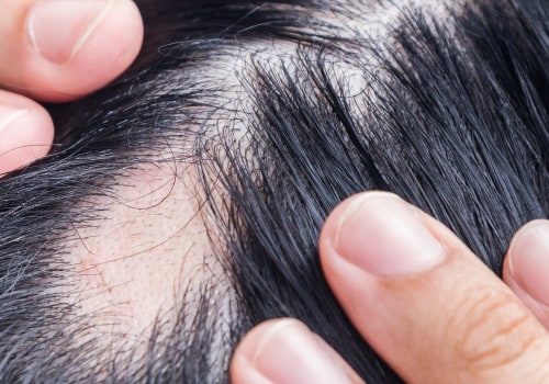 Understanding Alopecia: Causes, Treatments, and Prevention