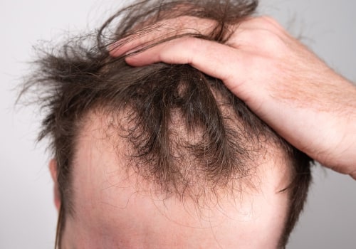 Stress Management for Hair Health: Tips and Techniques for Preventing Baldness and Promoting Regrowth